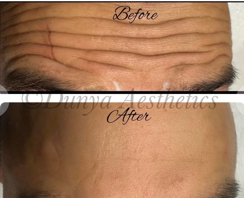 🤩 💉 Dunya Aesthetics in Bedford - Medic with an eye for artistry -   Valid from December 10, 2024 